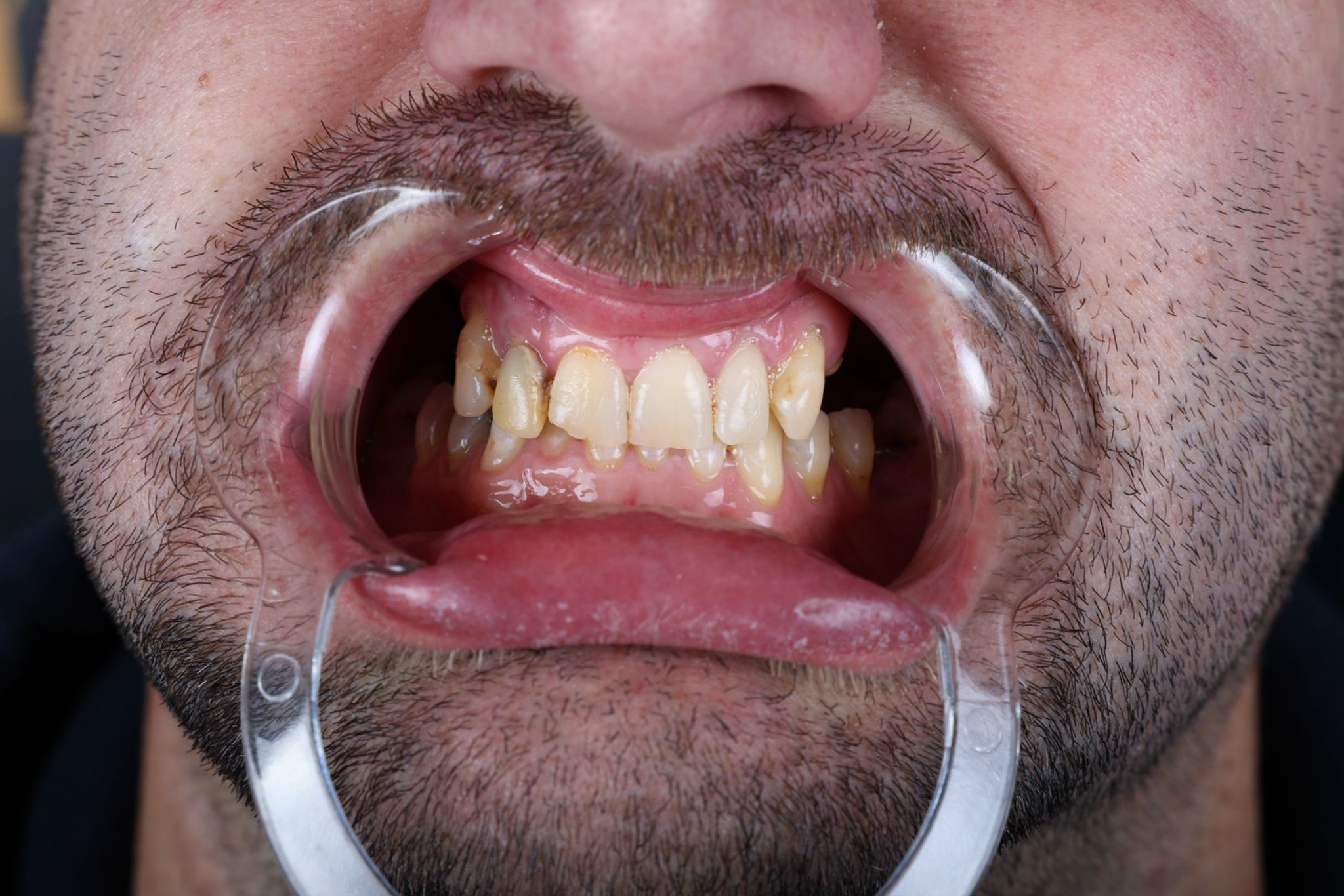 Before All-on-6 Implant Treatment